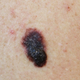 PREVIDNO NA SONCU: V boju proti kožnemu melanomu je ključno to