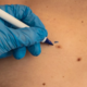 34-letnica zbolela za kožnim rakom. Vzrok? Pogosti virus na človeški koži
