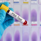 PSA test za prostato: Kako se izvaja in kaj pomenijo rezultati?