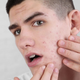 Brazgotine po aknah: zakaj nastanejo in kako jih lahko obvladujemo?