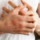 Atopijski dermatitis je več kot kožna bolezen