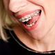 Primerjamo klasični in nevidni Invisalign zobni aparat!