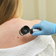 Ob dnevu boja proti kožnemu melanomu: Porjavelost kože ne predstavlja zdravja, temveč poškodbe