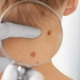 Kako hitro do dermatologa?