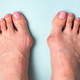 Operacija nožnega palca (hallux valgus) z minimalno invazivno metodo zdaj na voljo s povračilom stroškov od ZZZS. Potrebujete le napotnico!