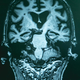 Novo upanje za bolnike z Alzheimerjevo boleznijo?