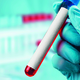 Novi presejalni test za raka prostate