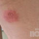 Slovenki so se po nogah pojavili boleči izpuščaji, zdaj opozarja na nevarnost majhnega hrošča (FOTO)