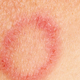 Rdeč kolobar na koži? Lahko gre za trdovratno glivico