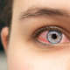 Kaj je konjunktivitis?