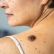 Melanom: dermatovenerologa o prepoznavanju sumljivih znamenj in zaščiti pred soncem | Vizita.si