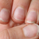 Spremembe barve nohtov, ki lahko opozarjajo na resne bolezni