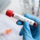HPV: tiha okužba, ki prizadene večino spolno aktivnih ljudi