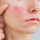 Kronična kožna bolezen, ki pogosteje prizadene ženske